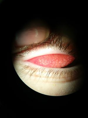 CL induced papillary conjunctivitis
16 yo male daily disposable wearer
Keywords: CLPC