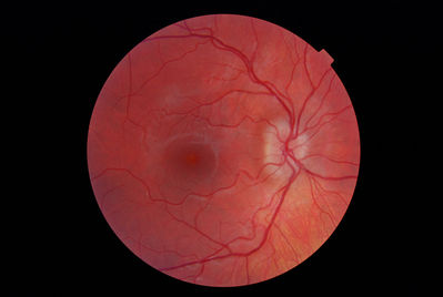 Sept 2012 - suspect Papilloedema?
Mild disc elevation and ill - defined margins in comparison to June 2011
