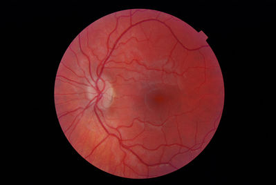 Sept 2012
Early disc elevation superiorly? Calcified lump superiorly not on previous years DRP.?
