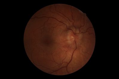 Bilateral Disc Swelling
