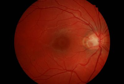 Optic disc pit
11 yo
VA 6/5
Normal FThF
