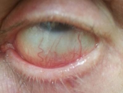 Diffuse episcleritis - inferior sector - resolved
