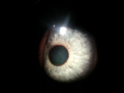 Spiral of clothing fibre under contact lens
Px felt lens discomfort since insertion. Rotation of lens caused spiral?
Keywords: under lens fibre spiral