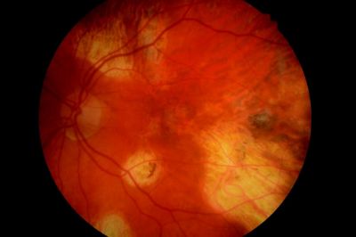 Old toxoplasmosis
45 years ago - painless loss of vision over 2 weeks. Flu-like illness. No Tx. Vision recovered spontaneously.
