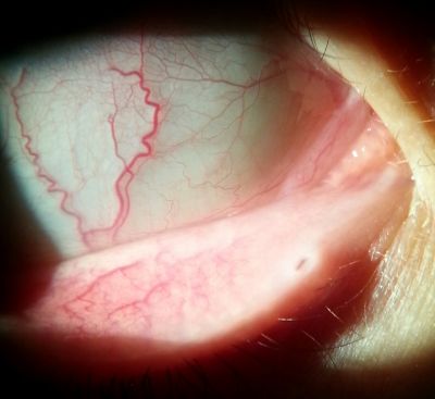 Conjunctival papilloma site after excision and cautery
