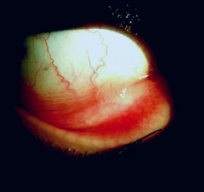 Conjunctival papilloma:

21 year old healthy female contact lens wearer has become aware of lump under right lid over the last 3 months. She thinks it has enlarged slightly since it was first noticed. There has been no pain or discharge and the lesion has not bled.
 
Slit lamp examination reveals a small (3mm horiz x 2mm vert) papilloma in the inferior fornix (see attached pic). There are around 5 discrete finger-like lobes with a thread-like vascular core. There is an obvious feeder vessel but no pigment o
