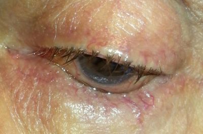 Entropion with trichiasis - blind eye

