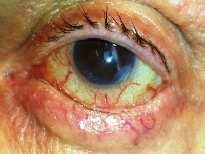 Entropion with trichiasis - blind eye

