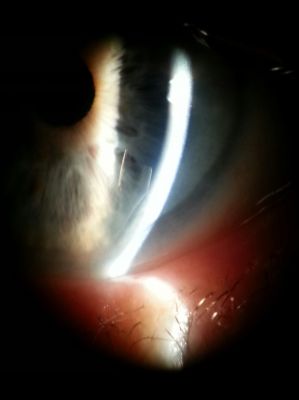 Small descemet's membrane detachment - post cataract
